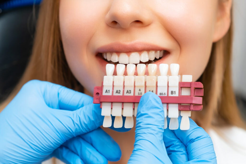 Veneers Troy NY