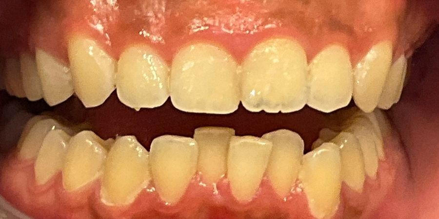 troy ny cosmetic dentist patient before and after image