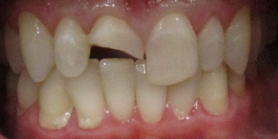 troy ny cosmetic dentist patient before and after image
