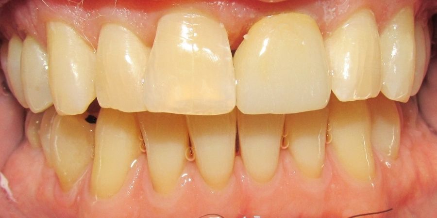 troy ny cosmetic dentist patient before and after image