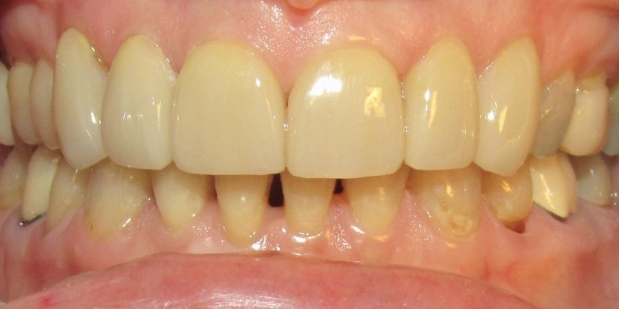 troy ny cosmetic dentist patient before and after image