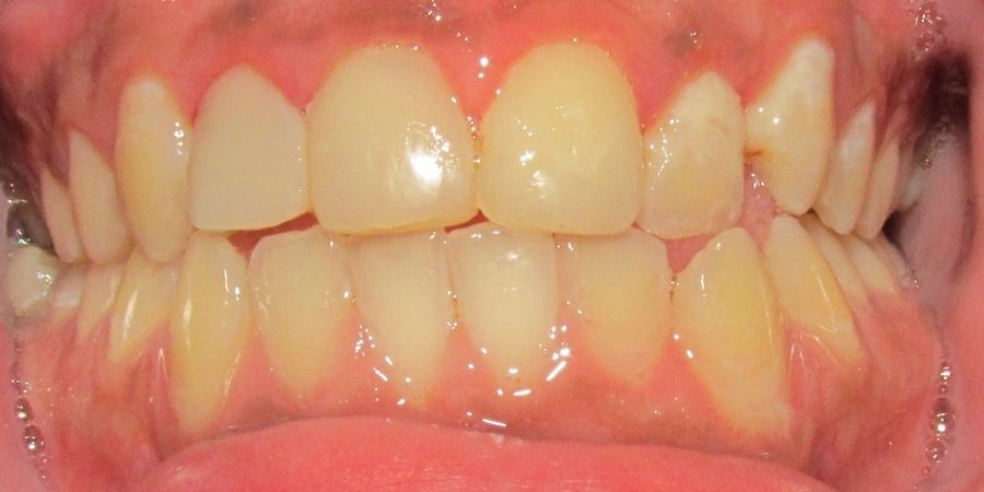 troy ny cosmetic dentist patient before and after image