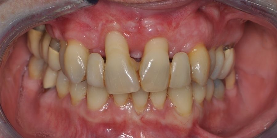 troy ny cosmetic dentist patient before and after image