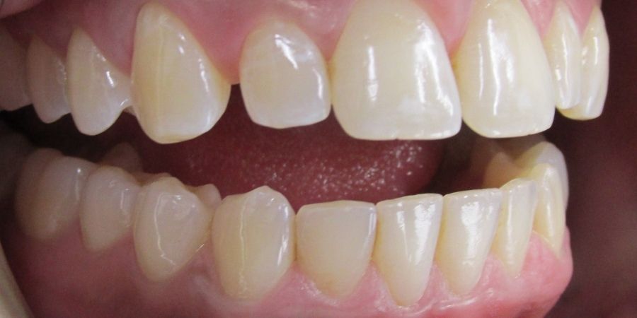 troy ny cosmetic dentist patient before and after image