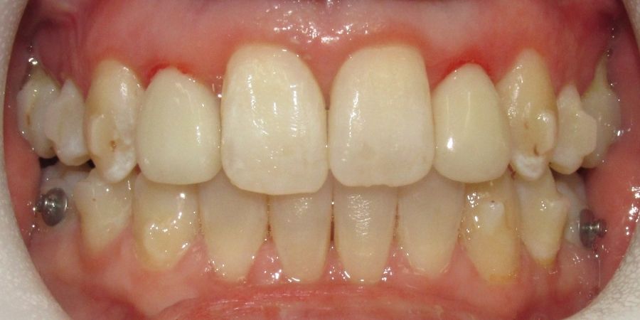troy ny cosmetic dentist patient before and after image