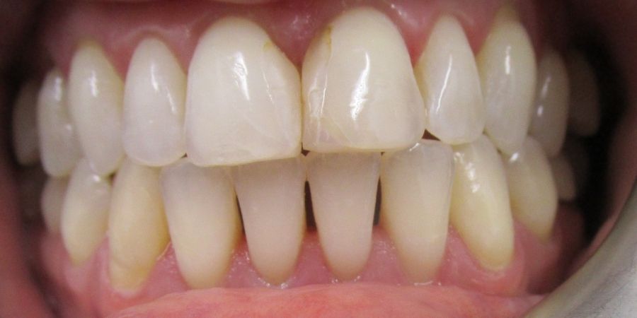 troy ny cosmetic dentist patient before and after image