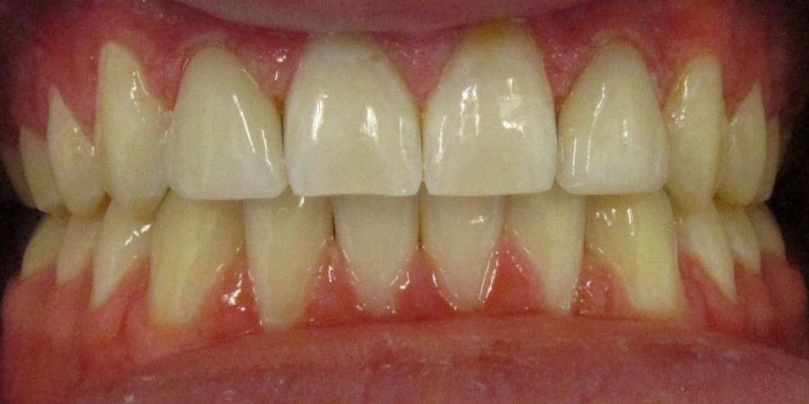 troy ny cosmetic dentist patient before and after image