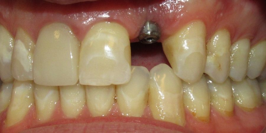 troy ny cosmetic dentist patient before and after image