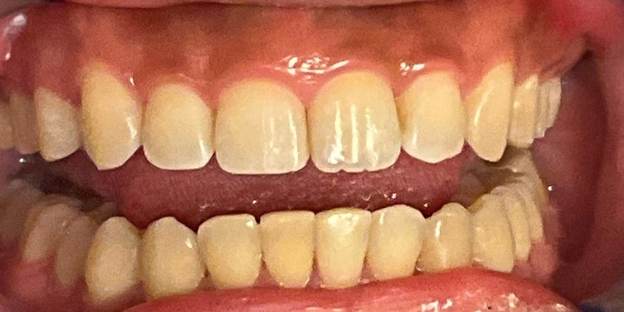 troy ny cosmetic dentist patient before and after image