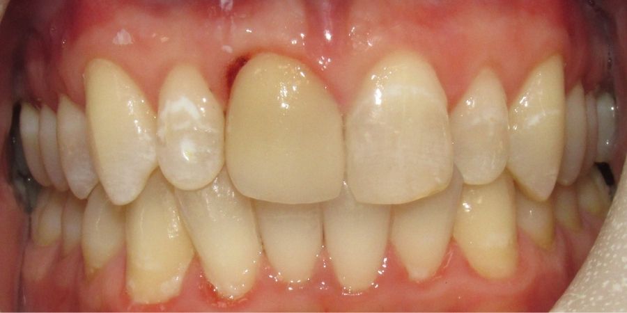 troy ny cosmetic dentist patient before and after image