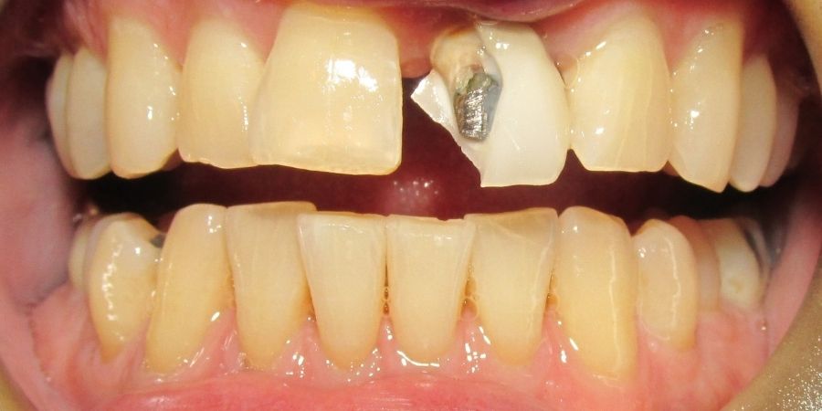 troy ny cosmetic dentist patient before and after image