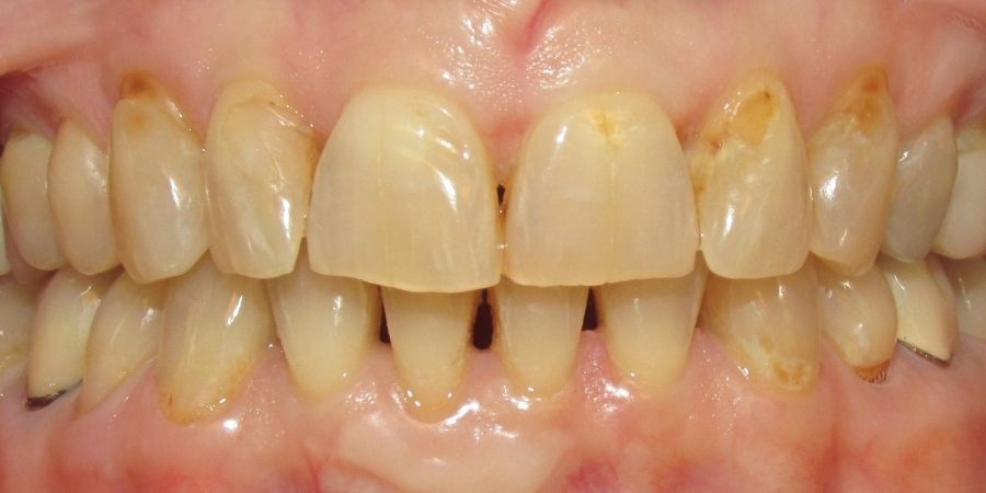 troy ny cosmetic dentist patient before and after image