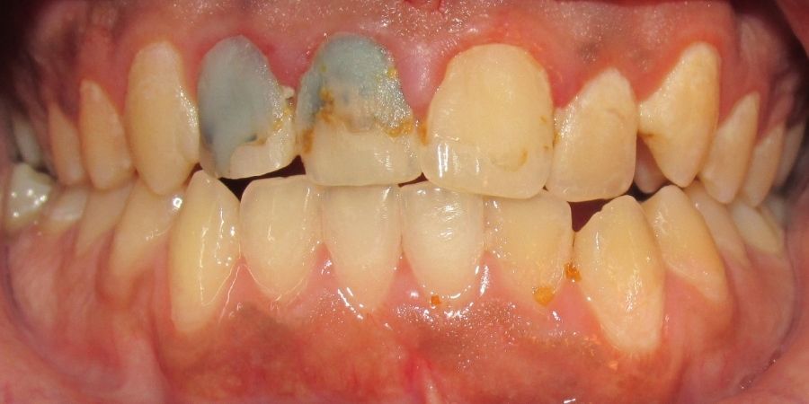 troy ny cosmetic dentist patient before and after image