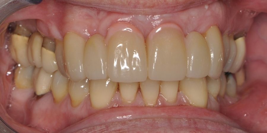 troy ny cosmetic dentist patient before and after image