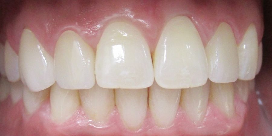 troy ny cosmetic dentist patient before and after image