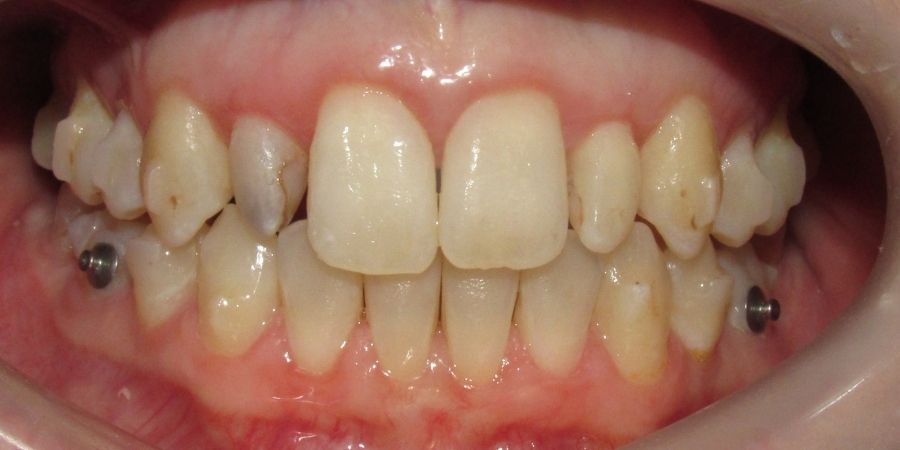 troy ny cosmetic dentist patient before and after image