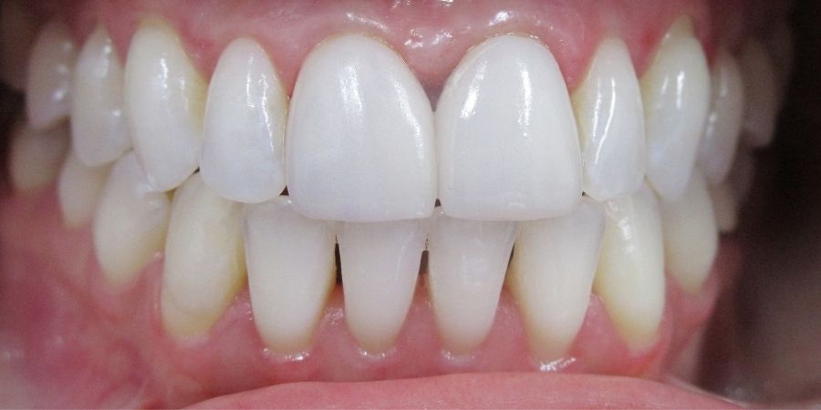 troy ny cosmetic dentist patient before and after image
