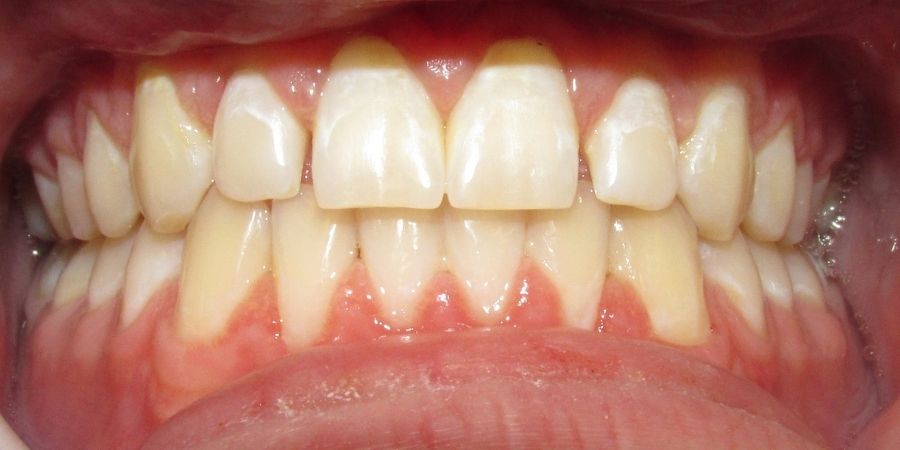 troy ny cosmetic dentist patient before and after image
