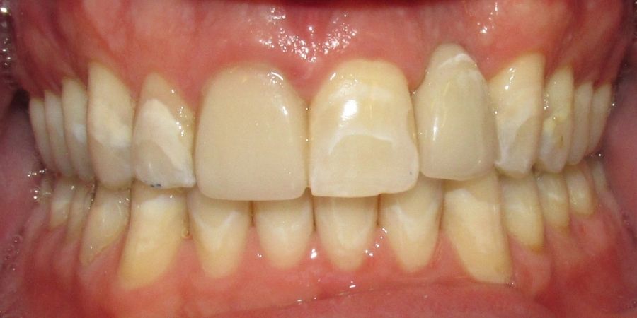 troy ny cosmetic dentist patient before and after image